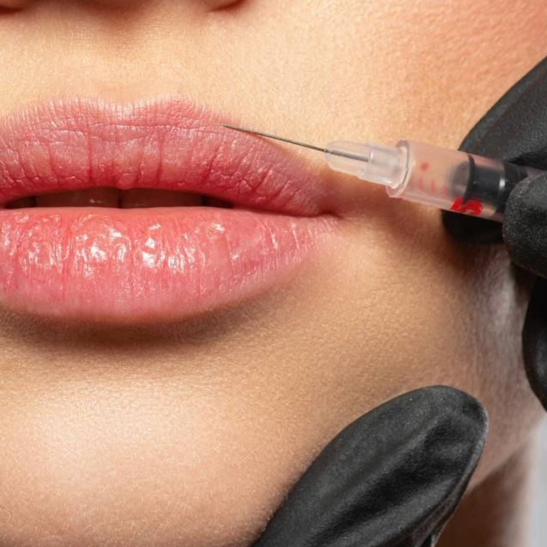 Lip Filler - 1 Syringe